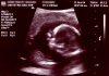 Liberian Catholic Bishops Break Ranks with Interfaith Council Over Public Health Bill Obsteric ultrasonography of a healthy female at 8weeks and 5days (By Doctor - Transferred from specialist.org en.women’s specialist to Commons., Public Domain Wikimedia)